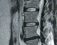 Bild zu Die richtige Matratze bei Rückenschmerzen oder Bandscheibenvorfall